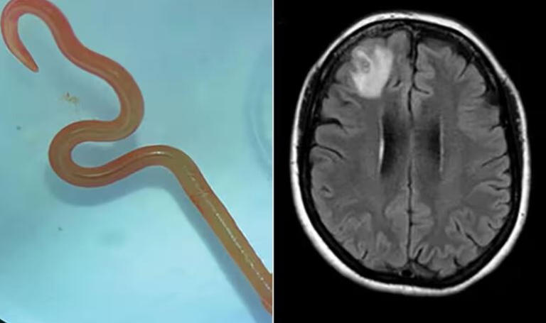 Australia,trovano un verme vivo di 8 centimetri nel cervello di una donna